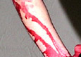 bloody arm